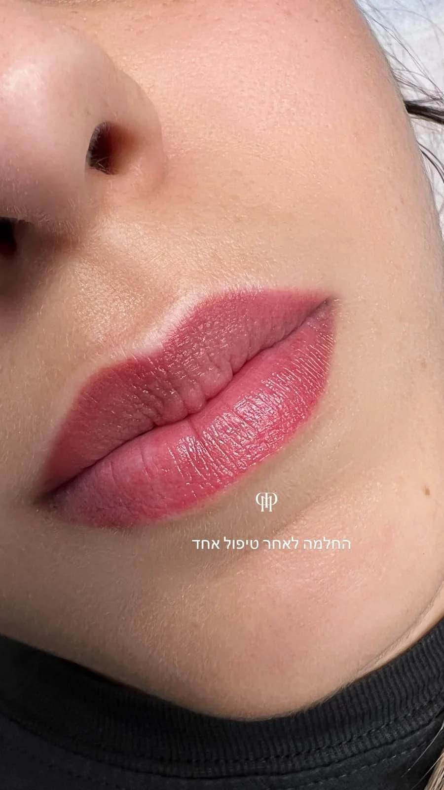 שפתיים בגוון ורוד-אדמדם אחרי החלמה מטיפול אחד, עם לוגו הסטודיו